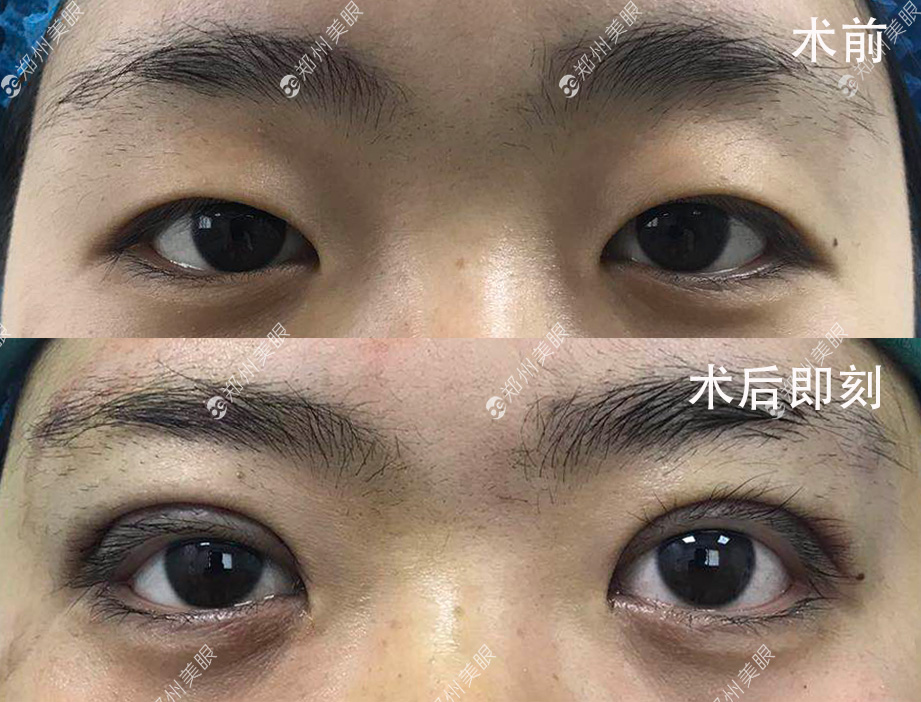 最新雙眼皮手術(shù)技巧，創(chuàng)新割雙眼皮方法解析